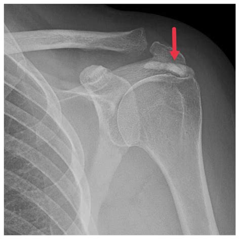 Hydroxyapatite Deposition Disease: A Comprehensive Review of ...