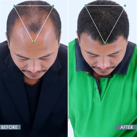 Best DHT Blocker for Men | ThriveCo DHT Blocker Supplement