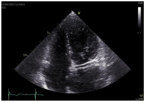 Anomalous Origin of Left Circumflex Artery from the Right Sinus of Valsalva in Cardiac Computed ...