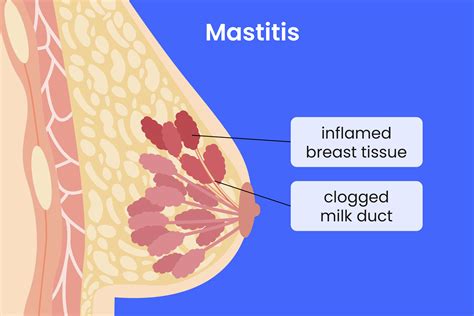 Home Remedies For Mastitis — Quick Relief Tips