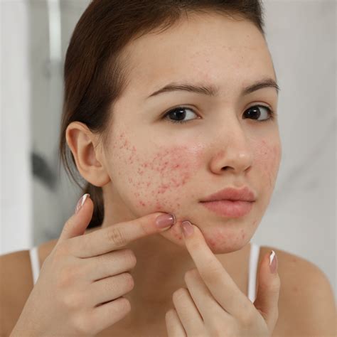 Acne: Causes, Treatments, and Prevention – Cosmosentials