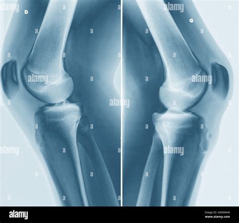 Osgood-Schlatter disease. Coloured X-rays of the knees of a 15-year-old patient comparing the ...