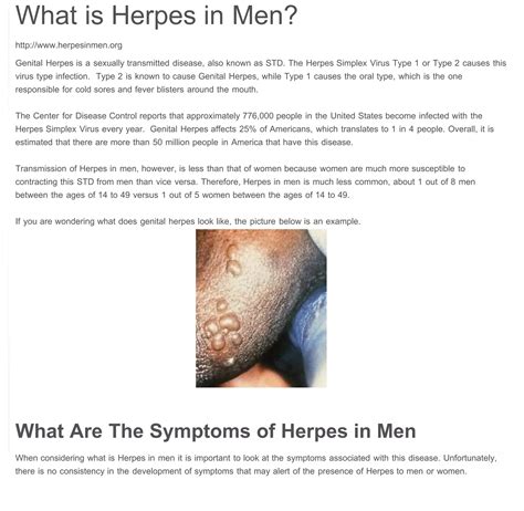 Mild Symptoms Of Herpes In Men