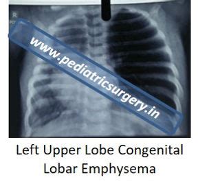 Congenital Lobar Emphysema | pediatricsurgery.in