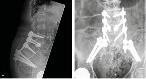 Osteoporoseassoziierte Fragilitätsfrakturen des Beckenrings ...