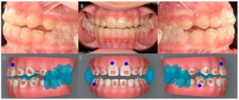 Skeletal, Dentoalveolar, and Soft Tissue Effects of Conventional and ...
