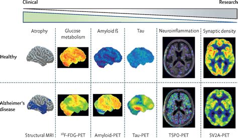 Amyloid-PET and 18F-FDG-PET in the diagnostic investigation of ...