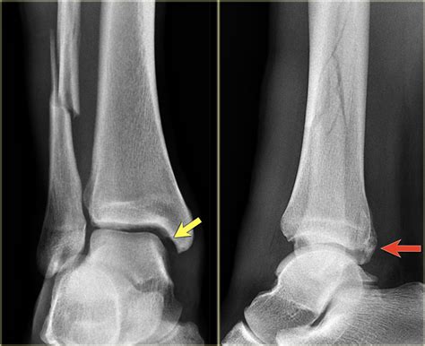 The Radiology Assistant : Ankle fracture - Weber and Lauge-Hansen Classification