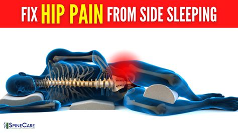 How to Quickly Get Rid of Hip Pain From Side Sleeping | SpineCare