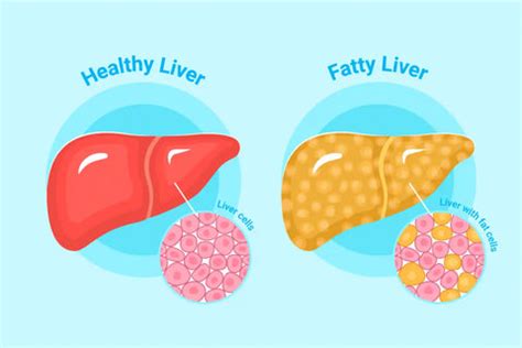 Understanding Liver Detox Supplements: Benefits, Ingredients, & Risk ...