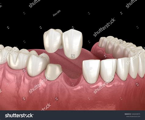 Cantilever Dental Bridge