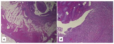 Use of Intraoperative Ultrasonography of the Small Bowel to Reduce ...