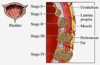 Bladder Cancer ~ Nursing Path