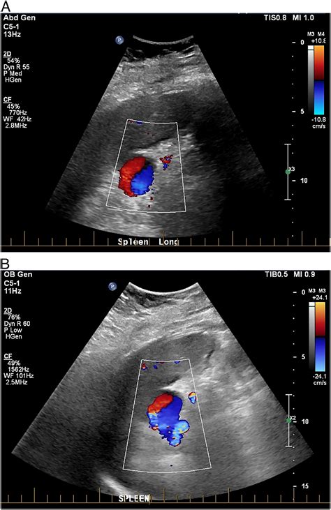 Splenic Artery Aneurysm Ultrasound