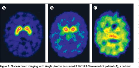 Image result for DaTscan Machine