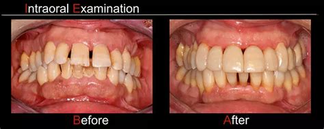 Patients using selective serotonin reuptake inhibitors have high ...