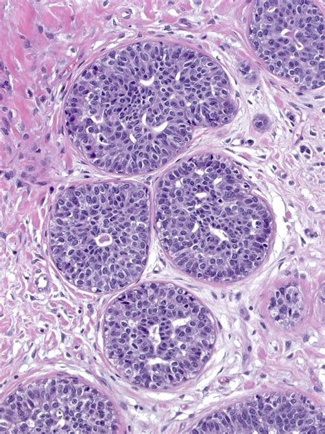 Atypical Ductal Hyperplasia (ADH) - MGH Learn Pathology