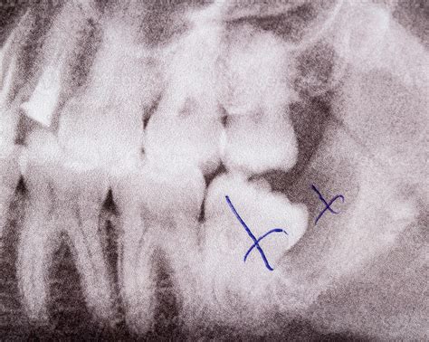 Wisdom Tooth Cyst Removal 的图像结果