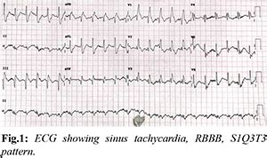 Massive Pulmonary Embolism despite Anticoagulation in a Post-Covid Patient