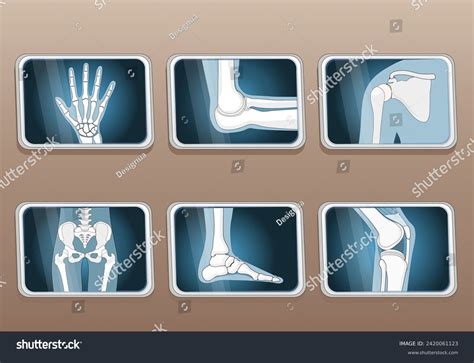 X ray articulation shoulder: Más de 7 ilustraciones y dibujos de stock con licencia libres de ...