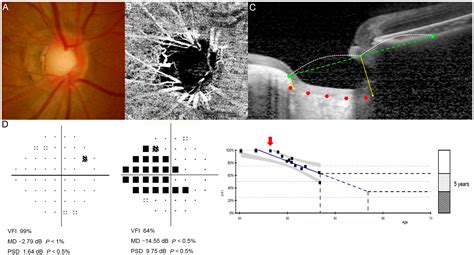 Prediction of Visual Field Progression in Myopic Normal Tension ...
