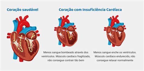 Insuficiência Cardíaca Tempo De Vida - ZULEDU