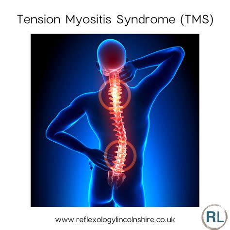 Tension Myositis Syndrome Treatment