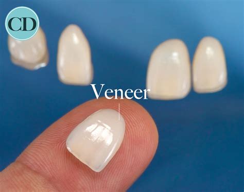 Dental Veneers Northern Ireland at Linda Aucoin blog