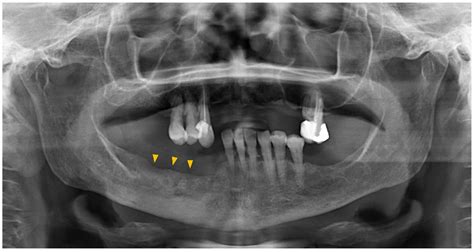 Medication-Related Osteonecrosis of the Jaws: A Comparison of SICMF ...