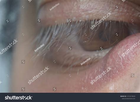 Image result for Big Boils Exploding