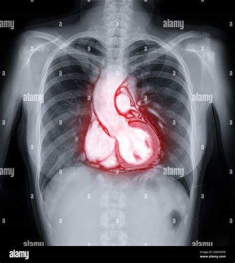 MRI heart or Cardiac MRI ( magnetic resonance imaging ) of heart for diagnosis heart disease ...