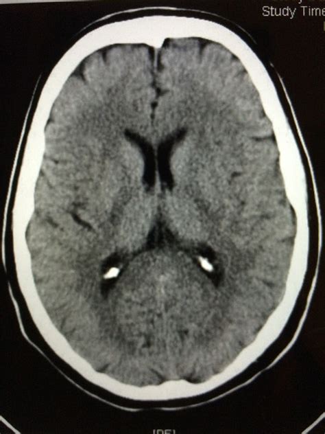 Image result for Normal Brain CT Scan