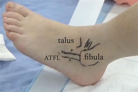 All-Inside Arthroscopic Anatomic Anterior Talofibular Ligament Repair ...