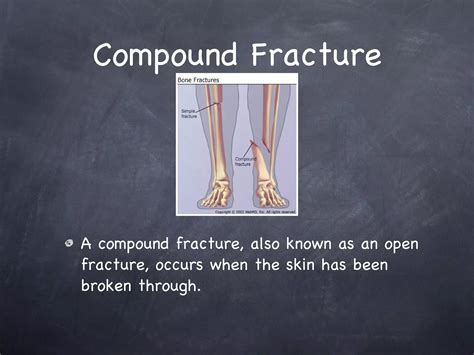 Comminuted, Simple, and Compound Fractures | PPT