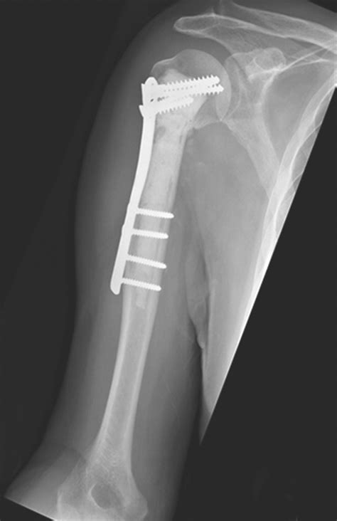 Fixation of pathological humeral fractures by the cemented plate ...