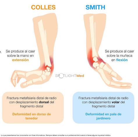 Fractura de Colles y Smith | Ortopedia y traumatologia, Medicina de urgencias, Escuelas de medicina