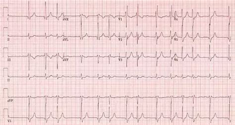 Elevated Lp(a) levels increase risk of Atrial fibrillation