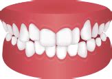 Clear Aligners in Hyderabad | Affordable Teeth Straightening Solutions