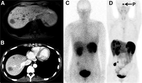Safety and Efficacy of 68Ga-DOTATATE PET/CT for Diagnosis, Staging, and Treatment Management of ...