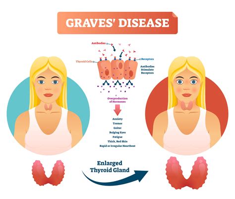 Graves’ Disease Eyes (Thyroid Eye Disease) | John A. Moran Eye Center ...