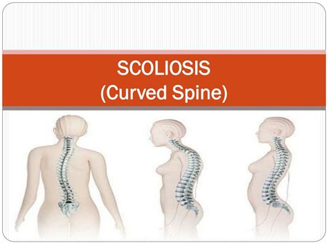 PPT - Scoliosis (Curved Spine) PowerPoint Presentation, free download - ID:7467898