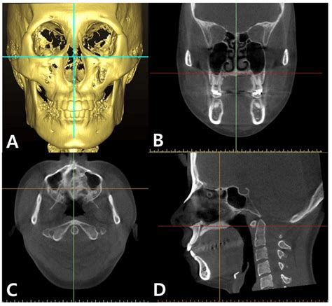A CBCT Evaluation of Midpalatal Bone Density in Various Skeletal Patterns