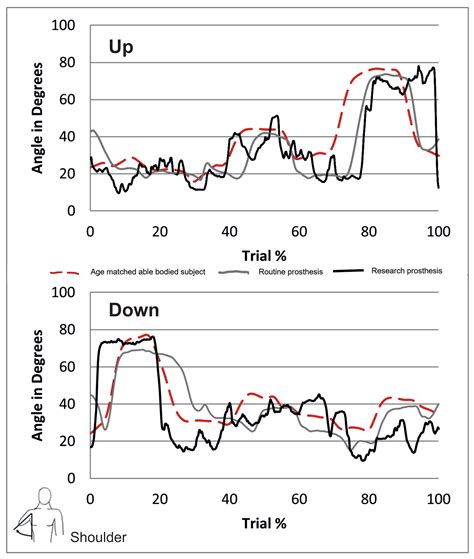 Novel Design of a Transradial Socket to Allow Independent Pro ...