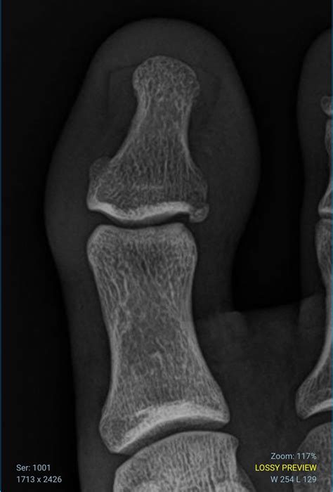 Big toe fracture not bending : r/FootFunction