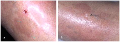 Shedding Light on Photodynamic Therapy in the Treatment of Necrobiosis ...