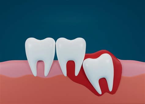 3d render of teeth with wisdom mesial impaction | Premium Photo