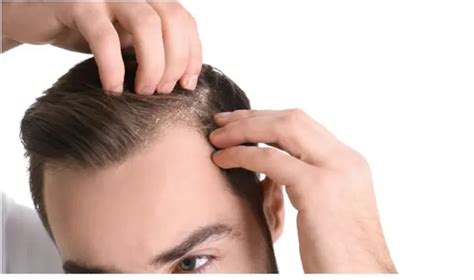 Is Dandruff Hereditary | H&S IN