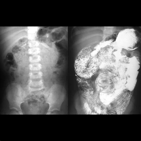 Pediatric Ascariasis | Pediatric Radiology Reference Article | Pediatric Imaging | @pedsimaging