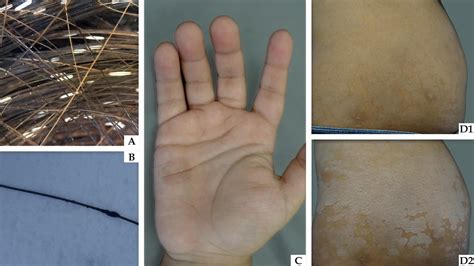 SciELO Brasil - White piedra, black piedra, tinea versicolor, and tinea ...