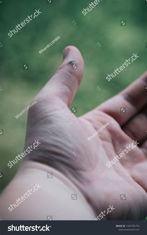 Splinter Finger 的图像结果